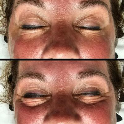 SKIN TIGHTENING
